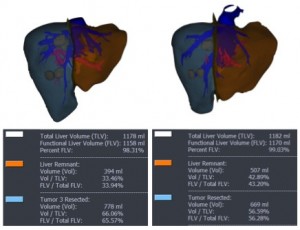 Figure 1. Virtual liver remnant (dark orange) projected at (a) 34% of total liver volume before portal vein embolization, and (b) 43% of total liver volume after portal vein embolization.