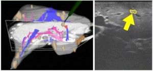 Figure 2. Tumor successfully located using CT-based navigation combined with ultrasound: (a) green probe indicates tumor on the image-guidance display of CT, and (b) yellow arrow indicates the tumor displayed in ultrasound. Initially, the tumor was not able to be localized using standard ultrasound alone.